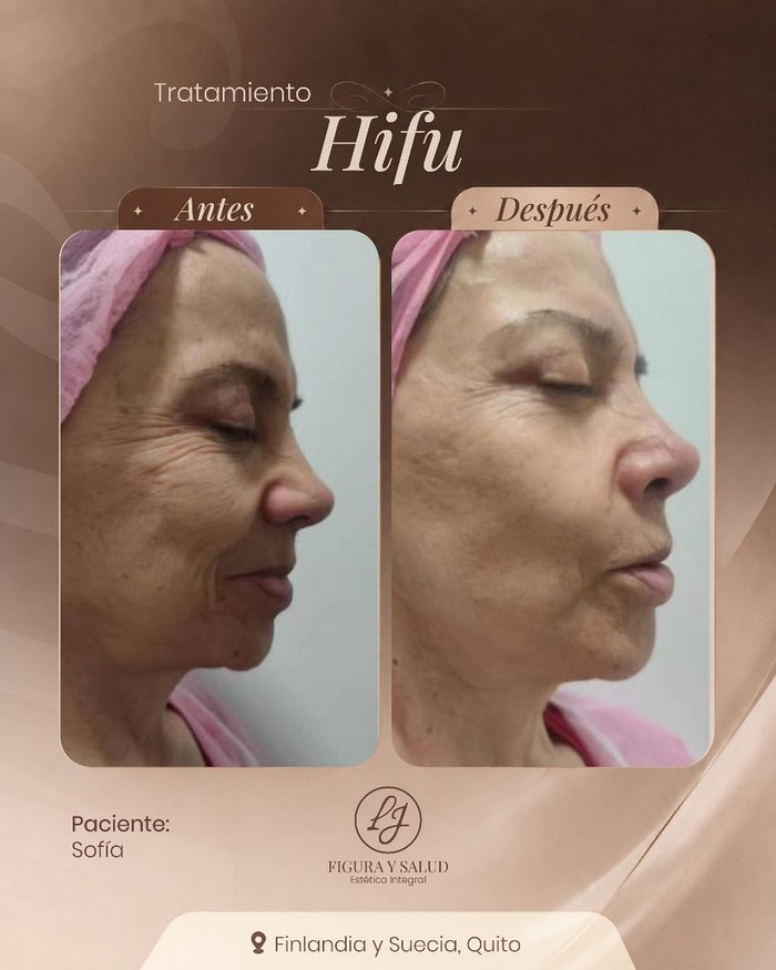Antes y después - Tratamiento Hifu