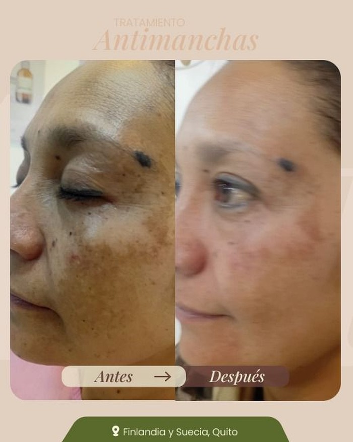 Antes y después - Tratamiento Antimanchas